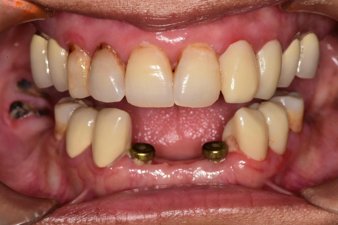Milled dental restorations on a lab rack