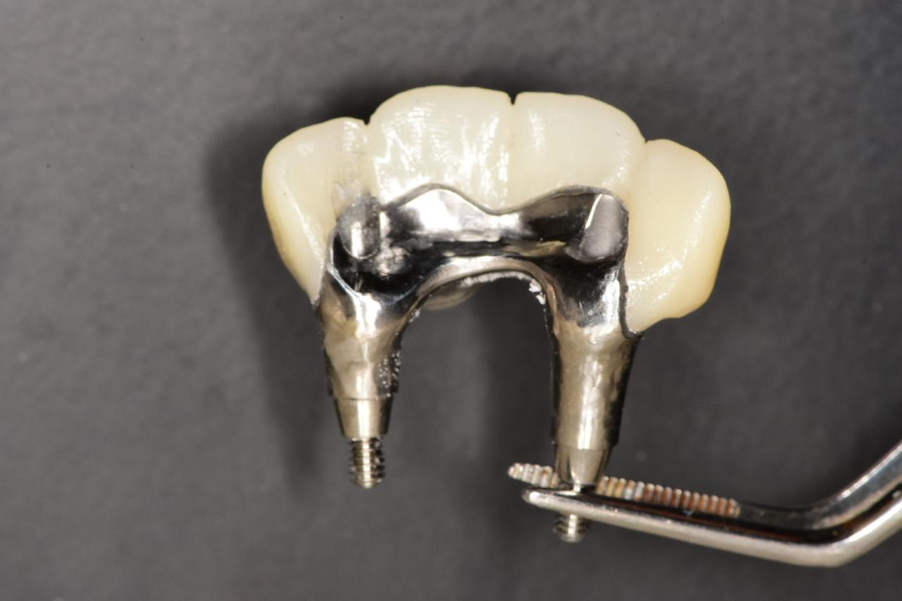 Milled dental restorations on a lab rack
